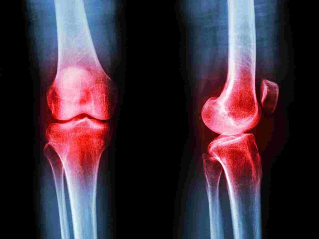 New Hope for Arthritis